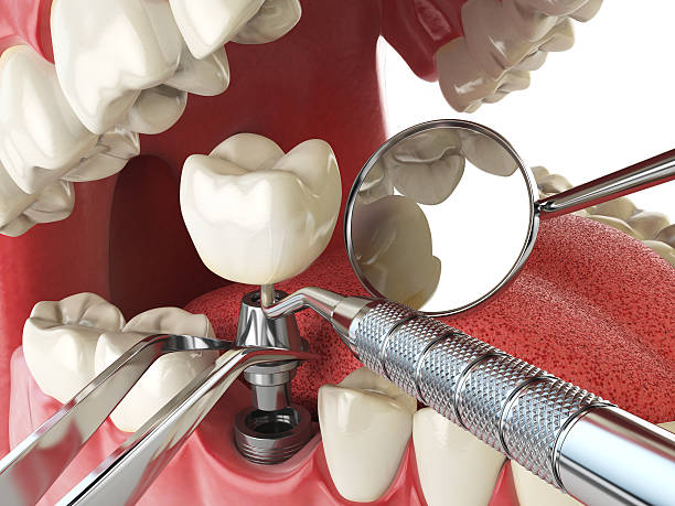 Best Broken or Chipped Tooth Repair in Rome City, IN